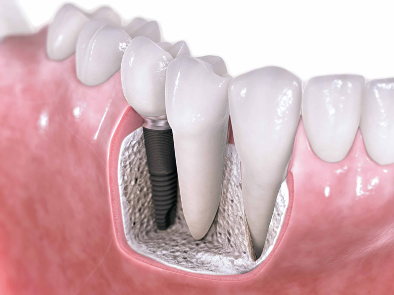 Implante dental - ¿Qué son?