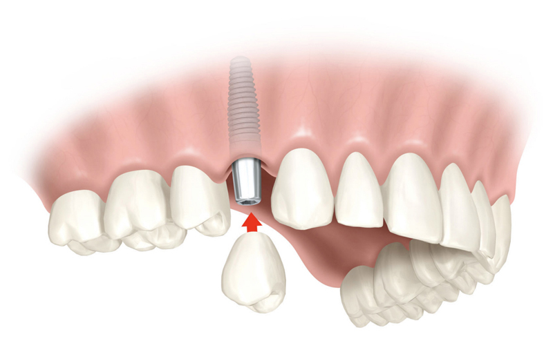 Implantes dentales -Cuando se han perdido varios dientes.